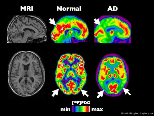 Meer kans op Alzheimer met veelgebruikte medicatie 4