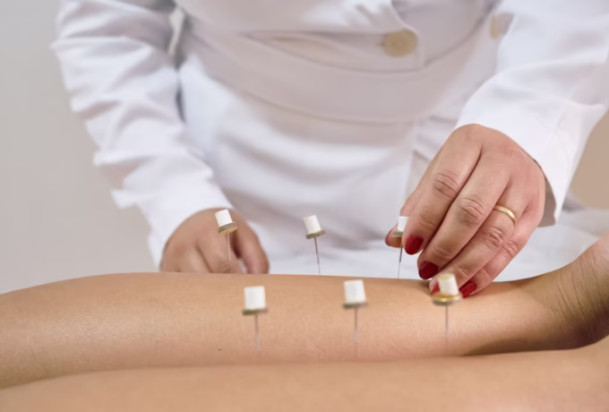 Ontstekingsremmend dieet en acupunctuur tegen depressie bij diabetes 12