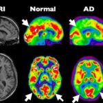 Alzheimer als diabetes type 3 13