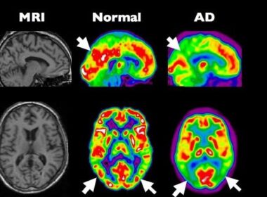 Alzheimer als diabetes type 3 7