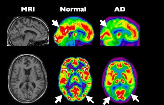 Alzheimer als diabetes type 3 3