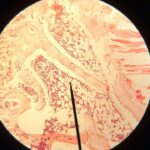 Vitamine C verlaagt overlijdensrisico bij voorstadia leukemie 5