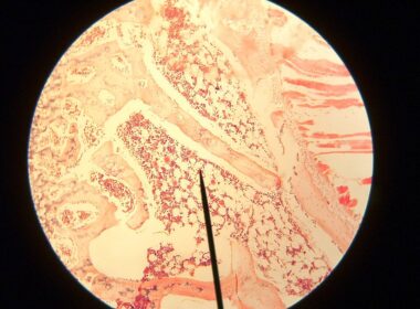 Vitamine C verlaagt overlijdensrisico bij voorstadia leukemie 7