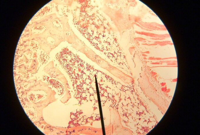 Vitamine C verlaagt overlijdensrisico bij voorstadia leukemie 3
