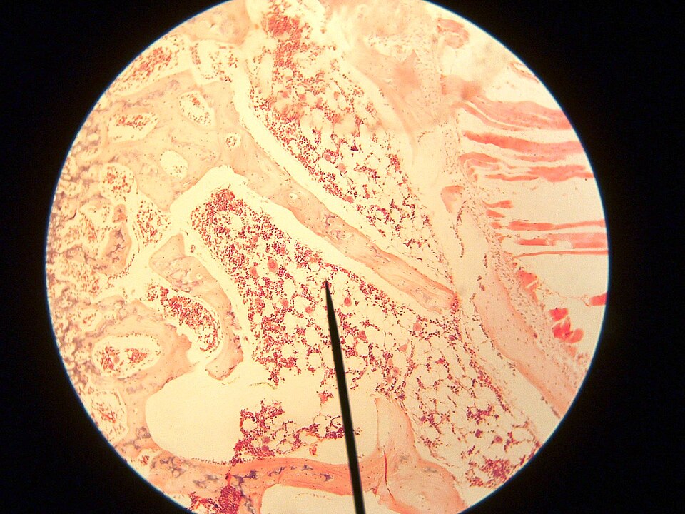 Vitamine C verlaagt overlijdensrisico bij voorstadia leukemie 3
