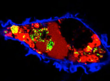 Hoe hoog cholesterol uitzaaiingen bevordert 3