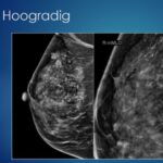 Waakzaam afwachten bij DCIS op korte termijn veilig 4