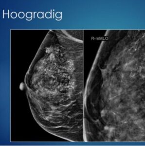 Waakzaam afwachten bij DCIS op korte termijn veilig 7