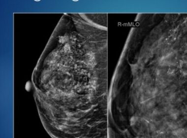 Waakzaam afwachten bij DCIS op korte termijn veilig 7