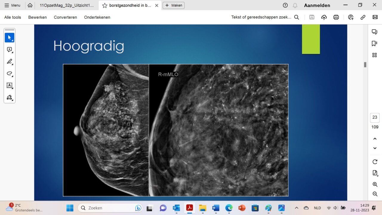 Lezing Femme Zijlstra: 'Hoe dicht is jouw borstweefsel?' | MMV