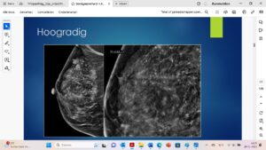 Studie toont veiligheid van waakzaam afwachten bij laaggradige DCIS 8