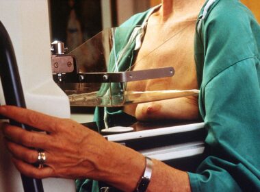 3D-mammografie bijna net zo vaak fout-positief 20