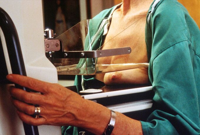 3D-mammografie bijna net zo vaak fout-positief 3