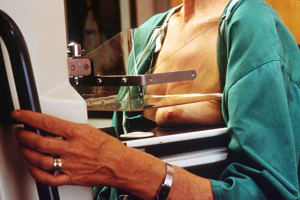 3D-mammografie bijna net zo vaak fout-positief 3