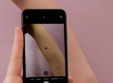 Vitamine D-suppletie lijkt melanomen te voorkomen 5