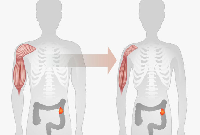 Overgewicht groter risico voor darmkanker dan aangenomen 12