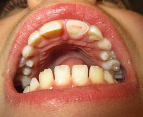 Enge mondbacteriën veroorzaken enge ziekten 3