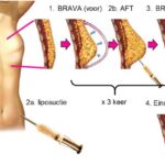 Volledige borstreconstructie met lipofilling, gewaardeerd en vergoed 16