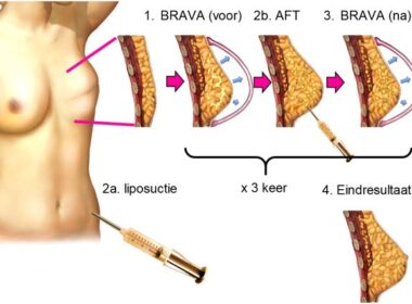 Volledige borstreconstructie met lipofilling, gewaardeerd en vergoed 5