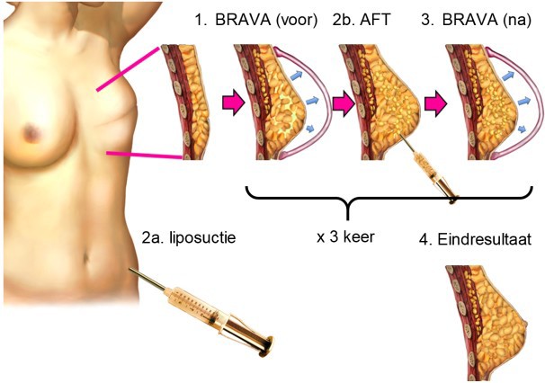 Volledige borstreconstructie met lipofilling, gewaardeerd en vergoed 3